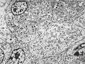 F, 68y. | APUD carcinoma mammae F, 68y. | APUD carcinoma mammae